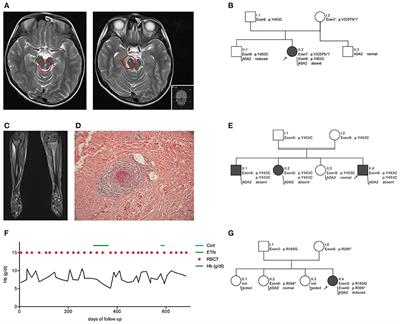 The Growing Spectrum of DADA2 Manifestations—Diagnostic and Therapeutic Challenges Revisited